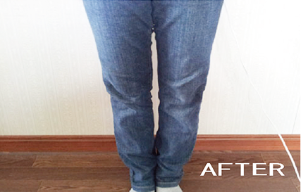 Ｏ脚調整アフター